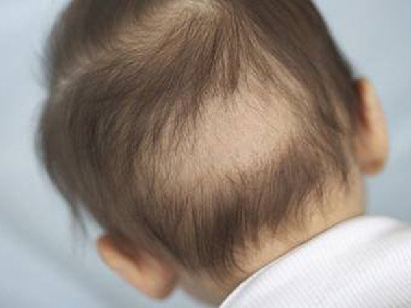 Tóc rụng cũng có thể là dấu hiệu thiếu canxi ở trẻ sơ sinh và trẻ nhỏ