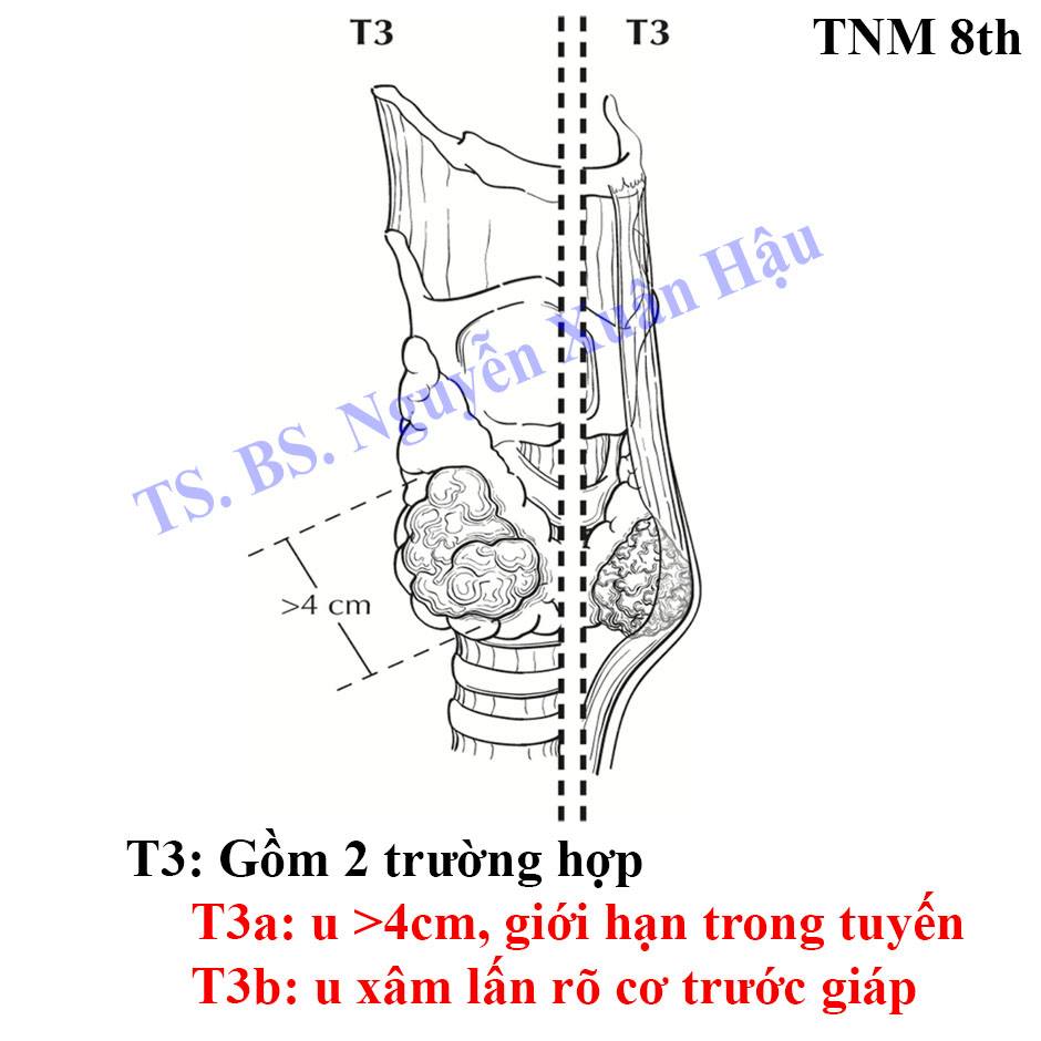 phân loại giai đoạn ünġ ṭẖư tuyến giáp gđ 3