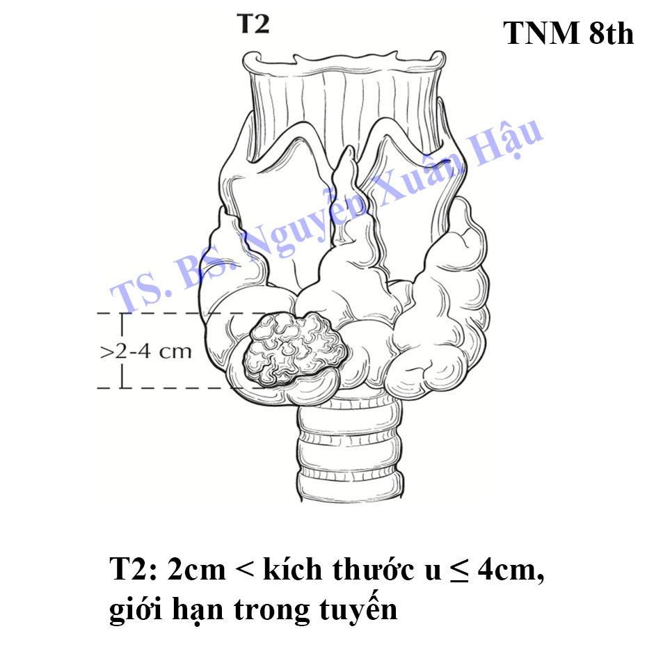 phân loại giai đoạn ünġ ṭẖư tuyến giáp gđ 2