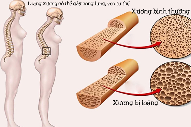 Loãng xương gây vẹo tư thế, còng lưng