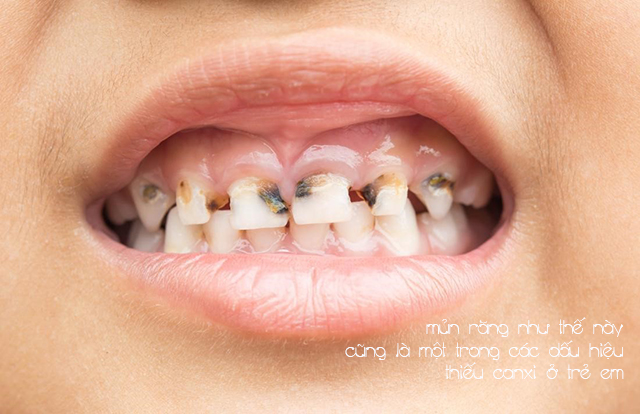 Mức canxi thấp có thể gây mủn răng ở trẻ